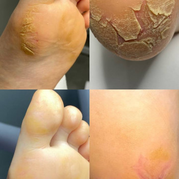 Співпраця з дерматологом (обробка дитячої стопи з кератодермією)