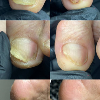 Подологічний педикюр літнім людям, для відновлення комфорту в повсякденному житті