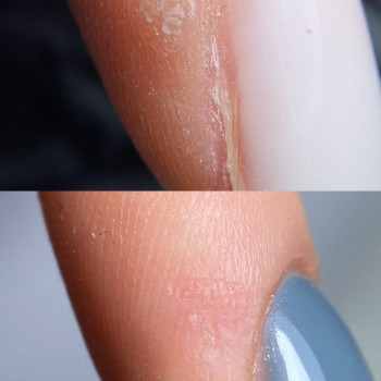 Видалення бородавки методом азотної кислоти