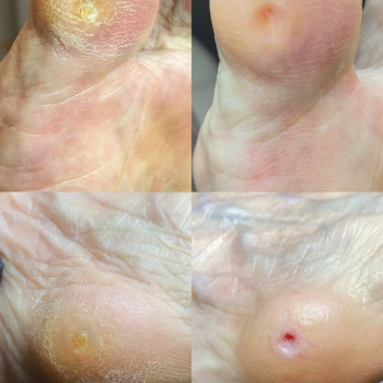 Зачистка стрижньової мозолі