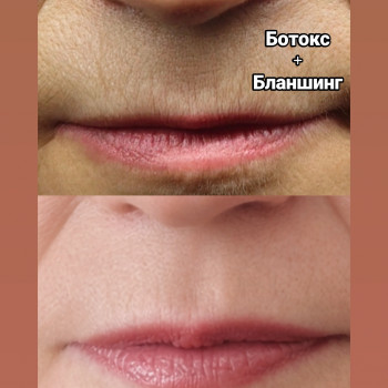 Кисетні зморшки. Корекція верхньої губи.