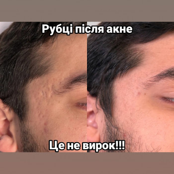 постакне, рубці