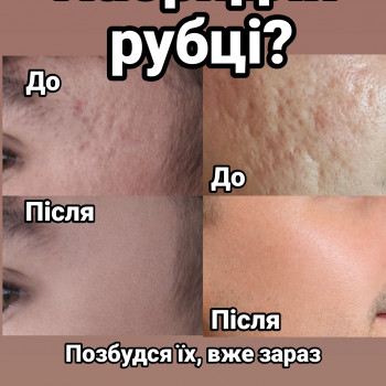 акне, постакне, рубці