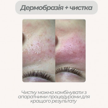 Дермобразія+чистка ідеальне комбо для тих, хто цінує час та бажає бачити класний результат