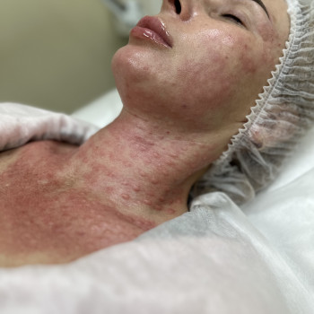 Біоревіталізація+пілінг PRX 33