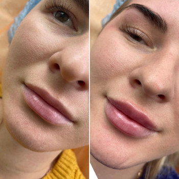 Корекція форми губ філлером