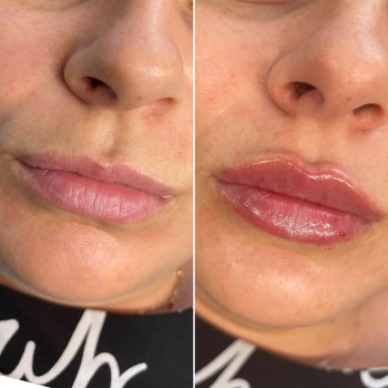 Корекція форми губ філлером