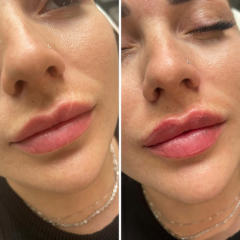 Корекція форми губ філлером