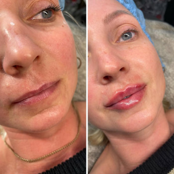 Збільшення губ