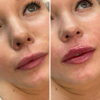 Збільшення губ