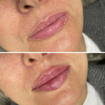 Збільшення губ препаратом Juvederm ultra smile (0,55)