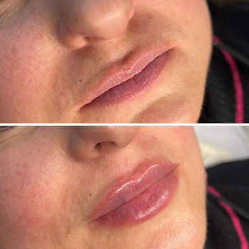 Збільшення губ, робота з тонкими губами