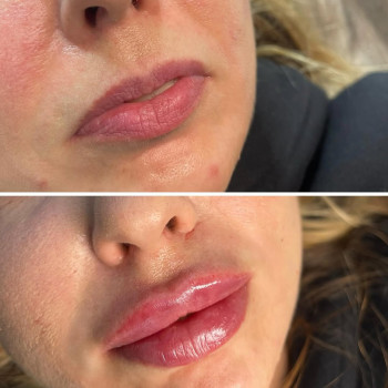 Збільшення губ, робота з асиметрією