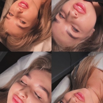 Збільшення губ