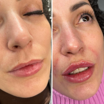 Збільшення губ