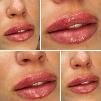 Збільшення губ