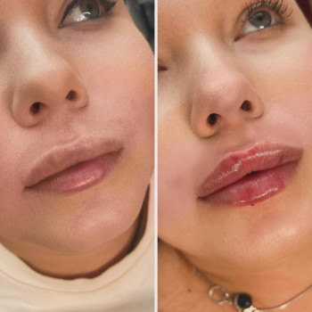 Збільшення губ