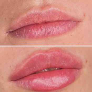 Збільшення губ