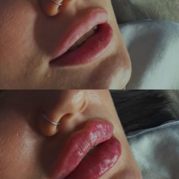 Збільшення губ