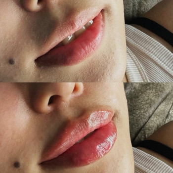 Збільшення губ