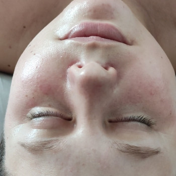 Массаж лица+ восстановление эпидермального барьера