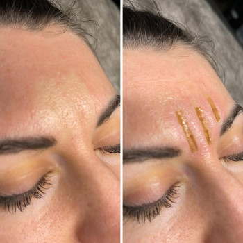 ✔️шліфування статистичних міжбрівних зморшок на фракційному лазері со2