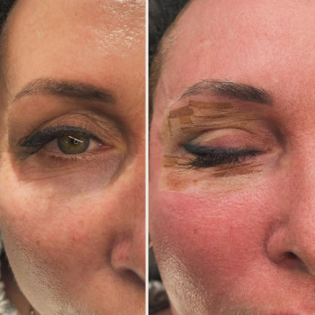 Лазерне шліфування періорбітальної зони очей
- скорочення шкіри навколо очей 
- усунення статистични...