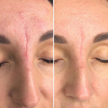 ✅Шлифовка шрама лазером СО2 
Проведено было 2процедуры с интервалом 2мес🔜продолжение будет в осенне-...