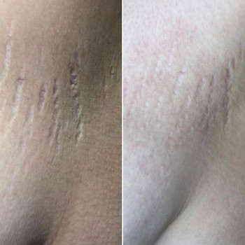 ✅до та після с різницею в два місяці,
Зроблено одна процедура,☑️
….

Показання для процедури
Процеду...