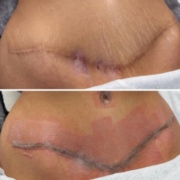 ☑️лазерна шліфовка рубця і розтяжок на фракційному лазері со2👌