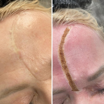 Як проходить видалення рубців та шрамів CO2 лазером
Шрам – це утворення сполучної тканини на місцях...