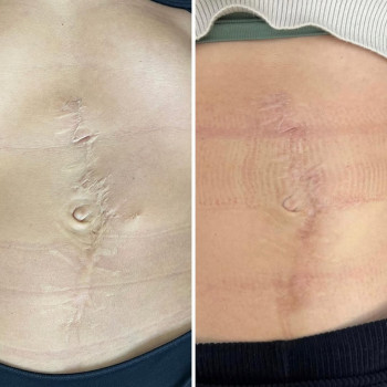 Шліфування гіпертрофічного рубця на фракційному лазері со2,виконана 1 процедура