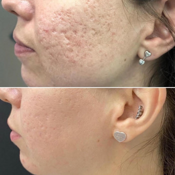 ✅ до та після з різницею в рік⤵️
🔝було проведено 3 шліфування з інтервалом 1.5міс на фракційному лаз...