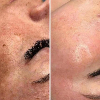 ✔️Лазерний пілінг в дії 👌
Лазерний пілінг обличчя на фракційному лазері Со2 – це ефективна омолоджую...