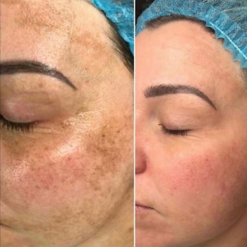 ✅ Лазерний пілінг — це одна з найефективніших апаратних процедур, що дозволяють без операційного втр...