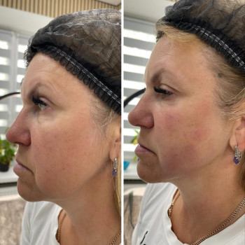 ☑️Smas lifting на сучасному апараті ULTRAFORMER ІІІ
📌Виконується 1 процедура 
📌Ефективність на 12-18...