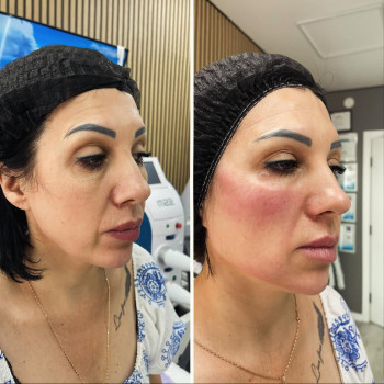 ✔️комплексна коррекція обличчя:
📌Smas lifting на Ultraformer MPT( нижня третина обличчя)
📌full face...