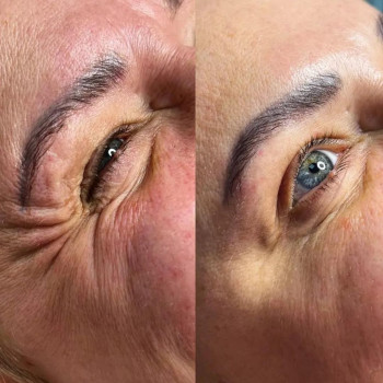 ботокс періорбітальної зони очей💉