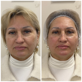 1 процедура колагеностимуляції препаратом Peteran