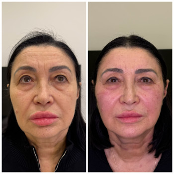 Комплексна робота з полімолочною кислотою 1 процедура

Обличчя - AesPlla
Очі - Juvelook