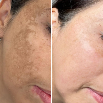 ☑️Лікування пігментації на апараті М22 (Lumenis) полягає в тому, що під впливом світла руйнується пі...