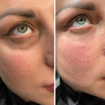 ☑️боротьба темних кол під очима і придання очам більш свіжого вигляду за допомогою натурального філе...