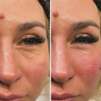 ✅корекція нососльозної борозни плазмогелем 
Цей філер зроблений з вашої власної плазми 💉❌не натягує...