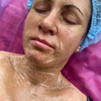 ✅ Ферментотерапія-має виражену антивікову дію за рахунок стимуляції синтезу еластину та колагену. Но...