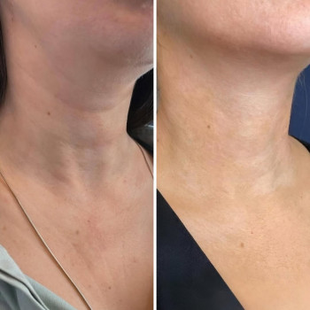 до та після з різницею 6 міс
…
раніше було проведено курс у комплексі полімолочної кислоти та мікр...