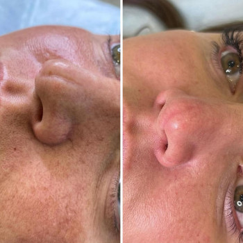 ☑️лазерне шліфування на фракційному лазері со2