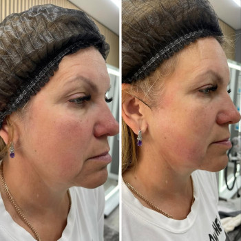 ☑️Smas lifting на сучасному апараті ULTRAFORMER ІІІ
📌Виконується 1 процедура 
📌Ефективність на 12-...