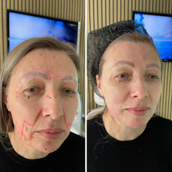 Ultraformer III — апарат, що моделює, підтягує та омолоджує всі три шари м’яких тканин обличчя: SMAS...