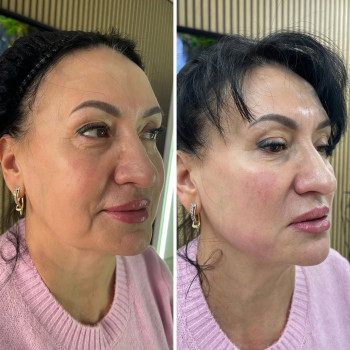 Smas lifting на ULTRAFORMER lll