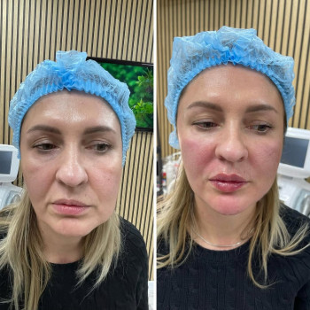 ☑️ об'ємна корекція обличчя 

🔝smas lifting на найефективнішому та топовому апараті Ultrafirmer ll...